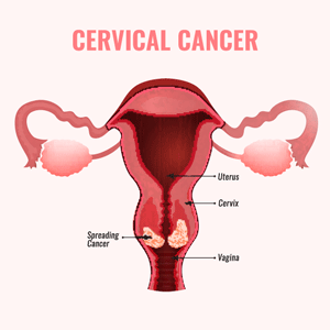 Cervical Cancer Attorney